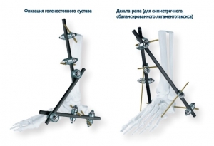 Набор конструкций для наружной фиксации